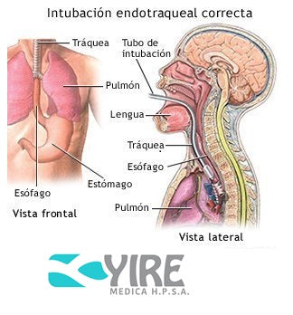 Inserción de un tubo endotraqueal